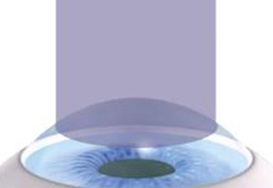 Corneal Crosslinking