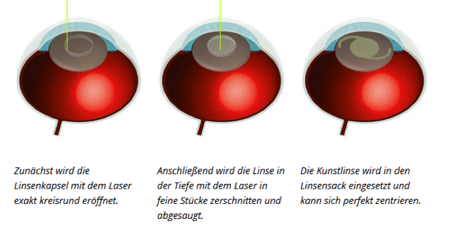 Ablauf Laser-OP