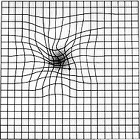 Amsler Gitter schwarzer Fleck