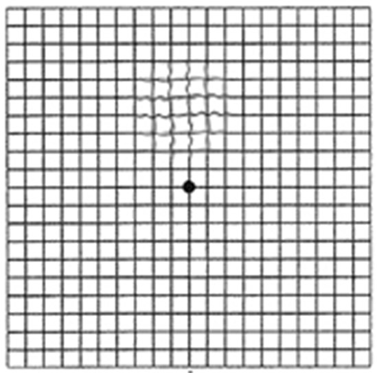 Das Amsler Gitter - ein kurzer Test, der viel verrät