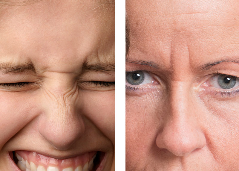 faltenbehandlung mit einem muskelrelaxans augen augenklinik sulzbach