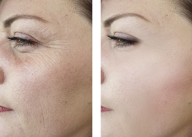 faltenbehandlung mit einem muskelrelaxans augen augenklinik sulzbach