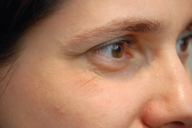 faltenbehandlung mit einem muskelrelaxans botox praeop augenklinik sulzbach