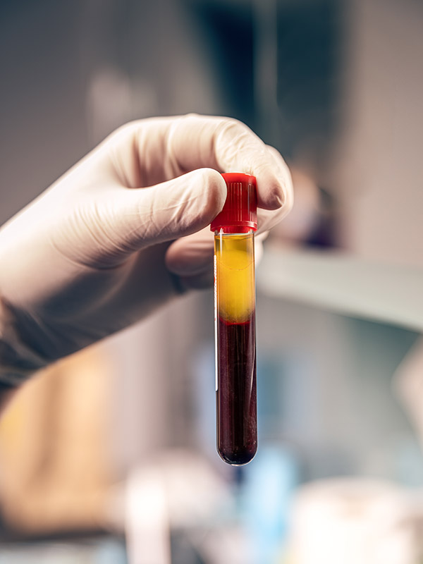 vampirlift aesthetische medizin augenklinik sulzbach