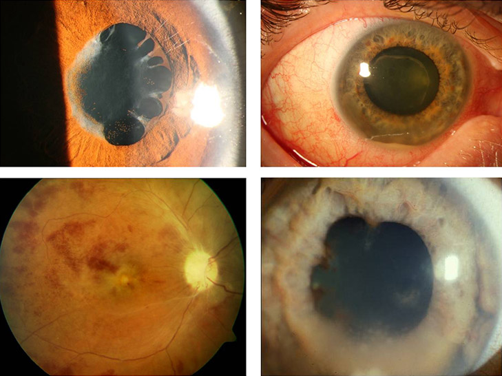 Autoimmunerkrankungen mit Uveitis