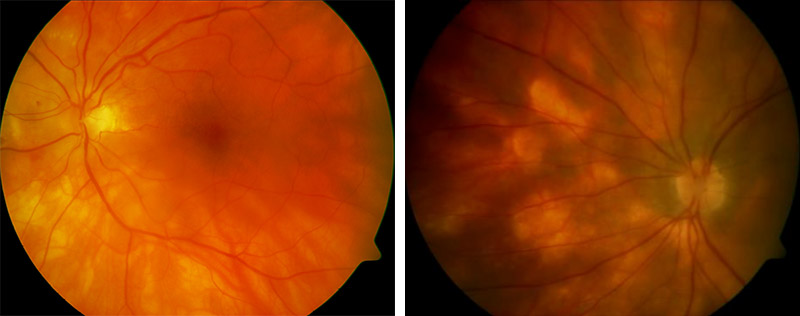 Birdshot-Chorioretinitis