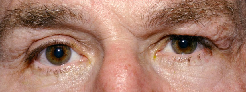 Brauenptosis