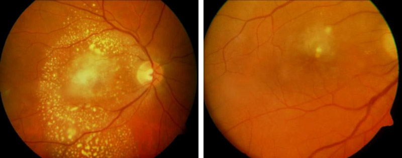 Birdshot-Chorioretinitis