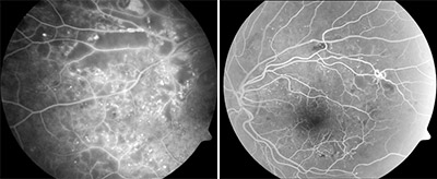 Nicht-proliferative diabetische Retinopathie