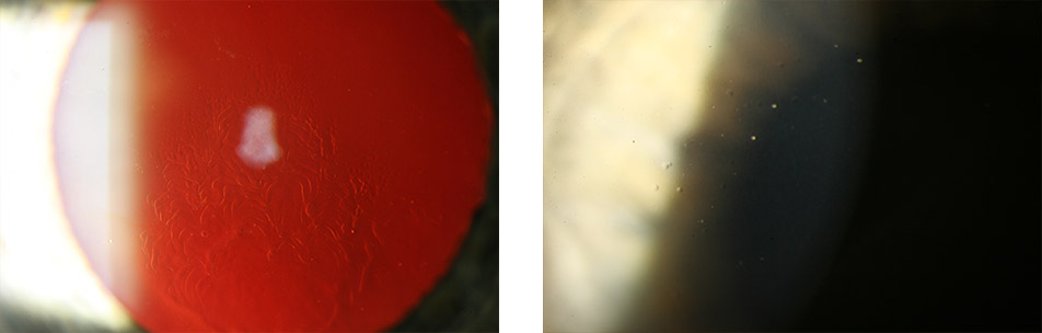 Epitheliale Dystrophie