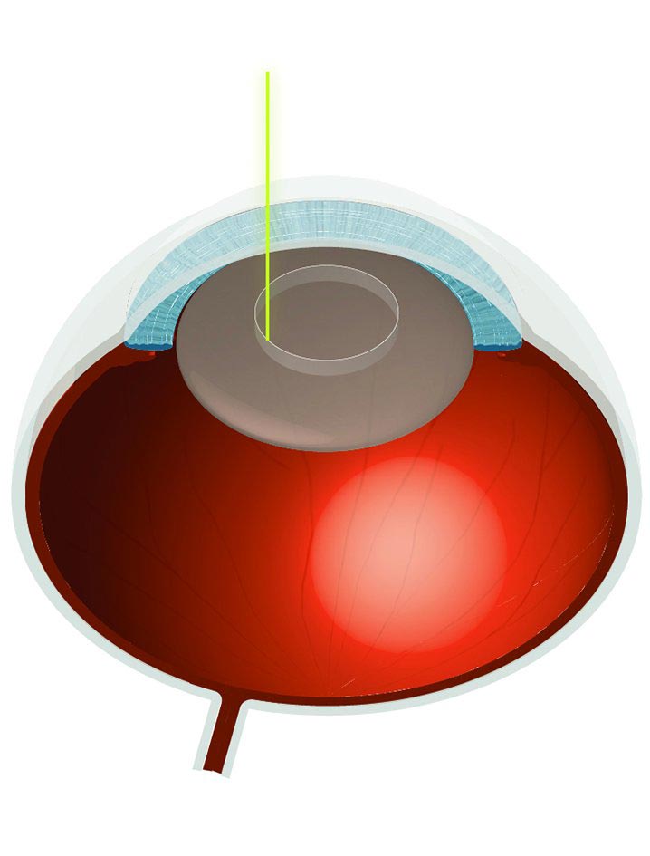 Grauer Star mit Laser