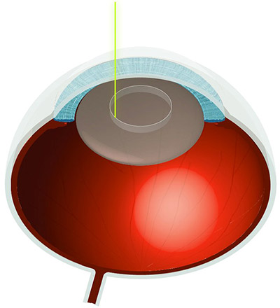 Laser Cataract Treatment