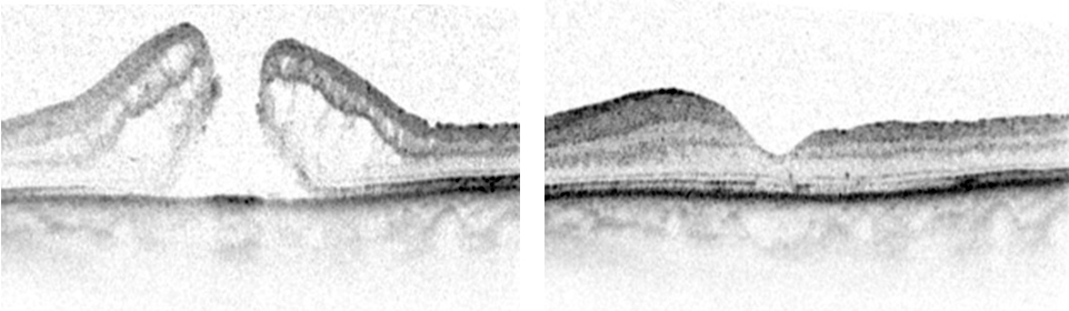 Makulaforamen vor und nach Vitrektomie