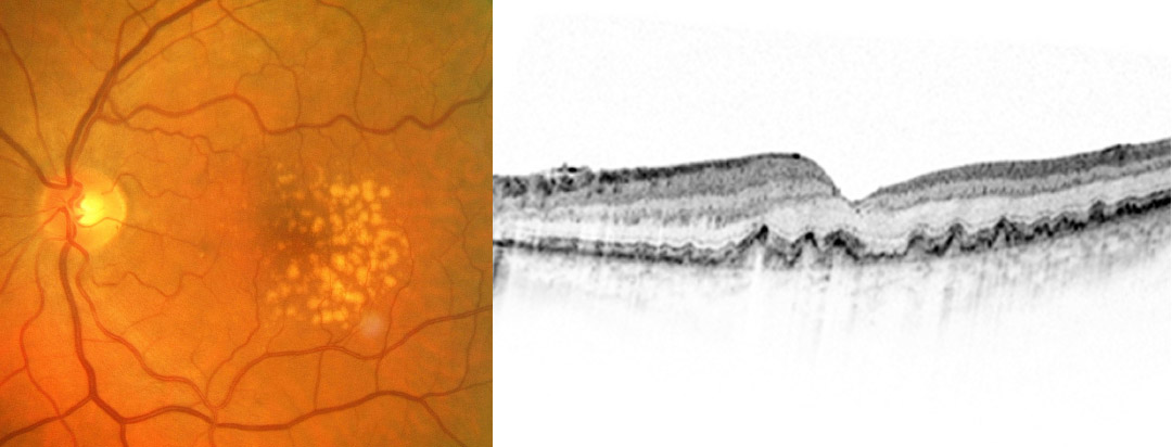 Frühe Form der trockenen AMD