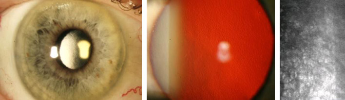 Fuchs'sche Endotheldystrophie