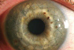 Artifical Cornea