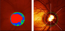 Heidelberg-Retina-Tomograph