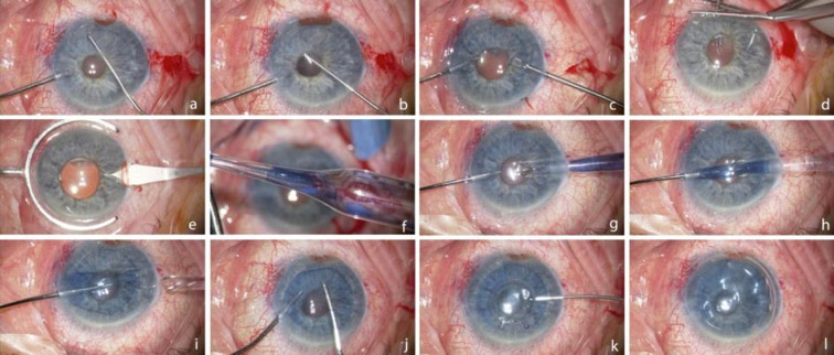 Implantation mit Sulzbacher Mikroinjektorkartusche