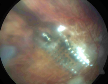 Retinal Chip