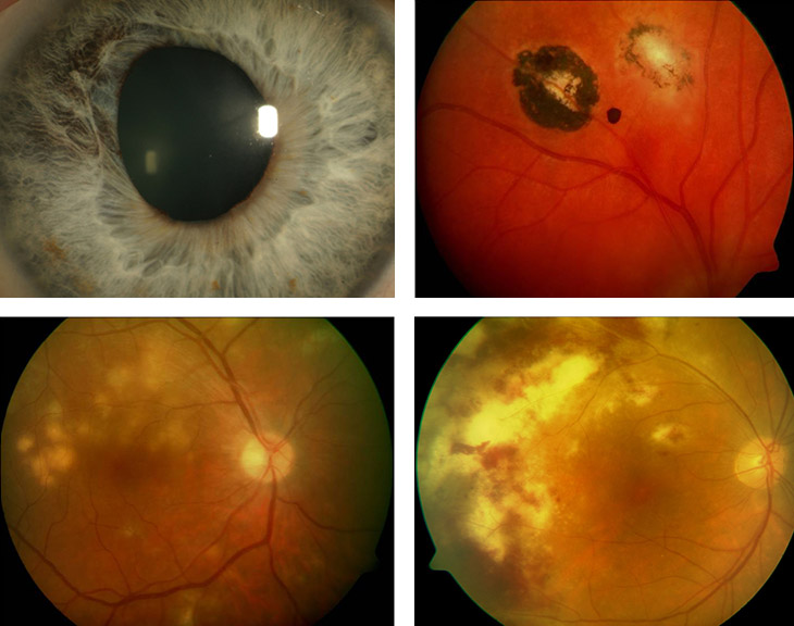 infektiöse Ursachen der Uveitis