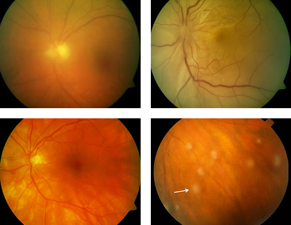 Komplikationen der Uveitis