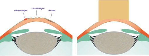 Laser-Smoothing