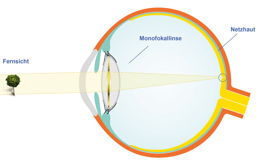 Monofokallinsen