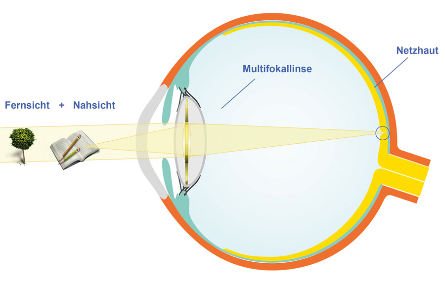 Presbyopia Treatment