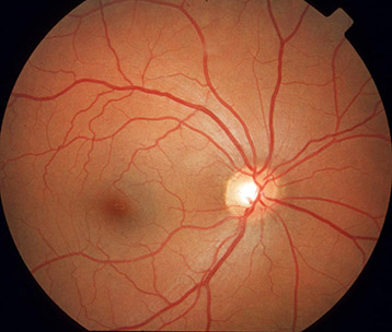 Augenärztlicher Blick auf den Hintergrund eines gesunden Auges