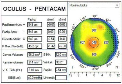 Pachymetrie