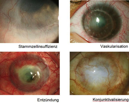 Nicht erfolgreiche Hornhauttransplantation