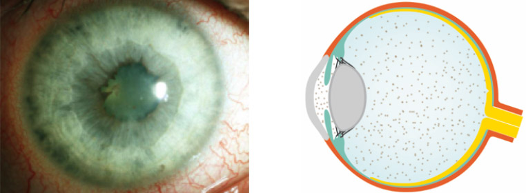 Panuveitis