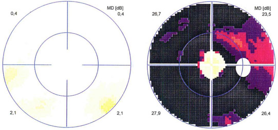 Gesichtsfeld bei Retinitis Pigmentosa