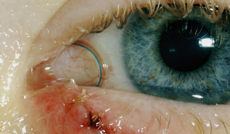 Ringintubation