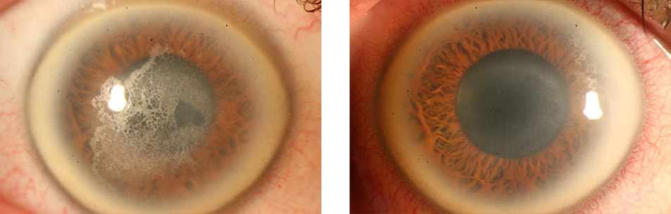 Schnyder-Dystrophie vor und nach Excimer-Smoothing