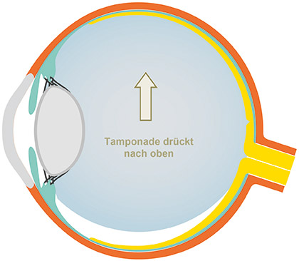 Tamponade