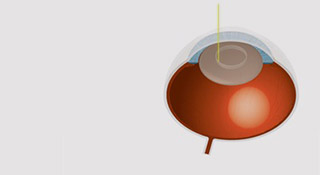 Grauer-Star-Operation mit Laser