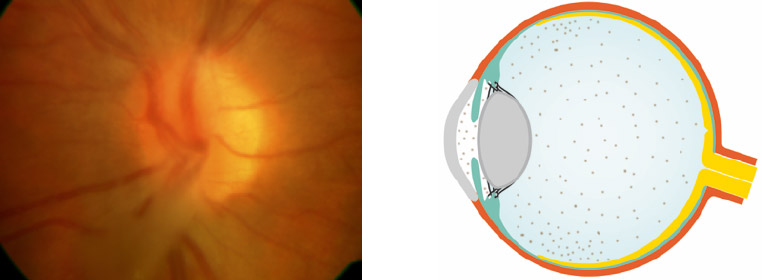 Uveitis intermedia