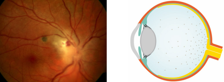 Uveitis posterior