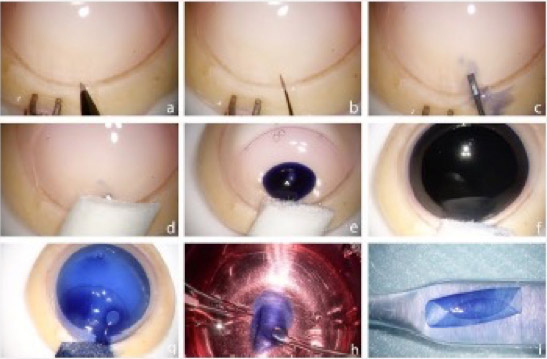 Vorpräparierte Teiltransplantate